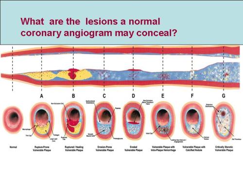 Lesions A to F may be totally missed by conventional coronary angiogram