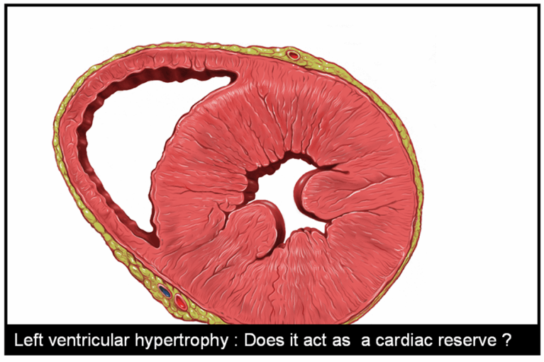 Advantages of Left ventricular hypertrophy (LVH) | Dr.S.Venkatesan MD