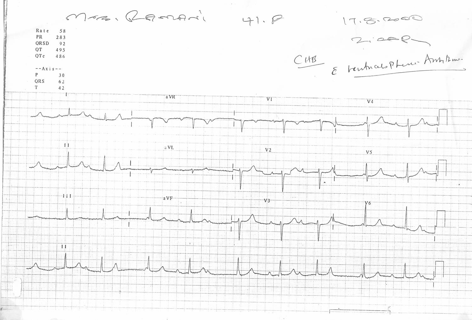 ecg-ventriculophasic-21