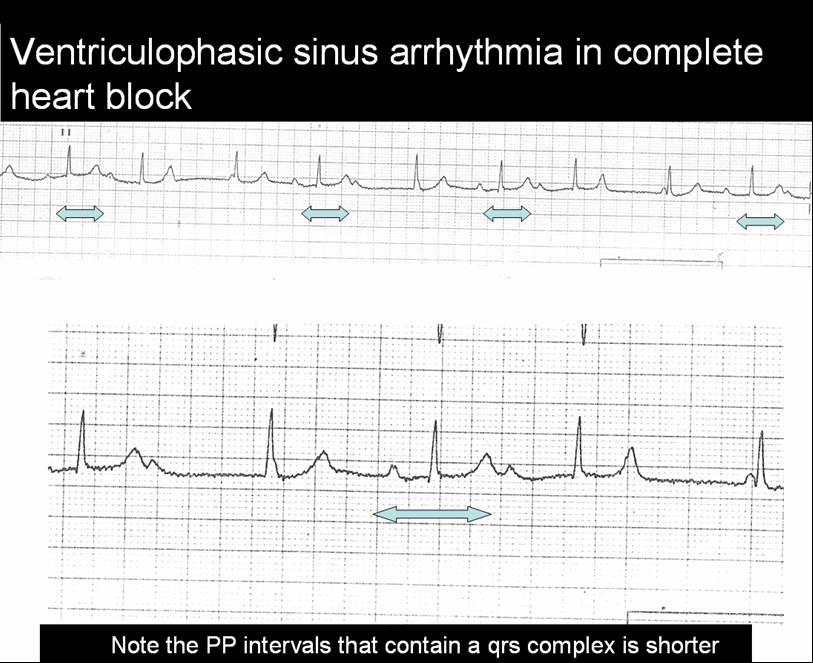 ecg-ventriculophasic-sinus-arrhytmia1