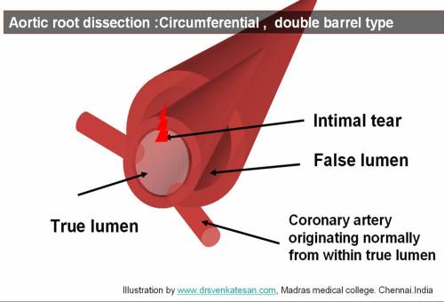 aortic-dissection