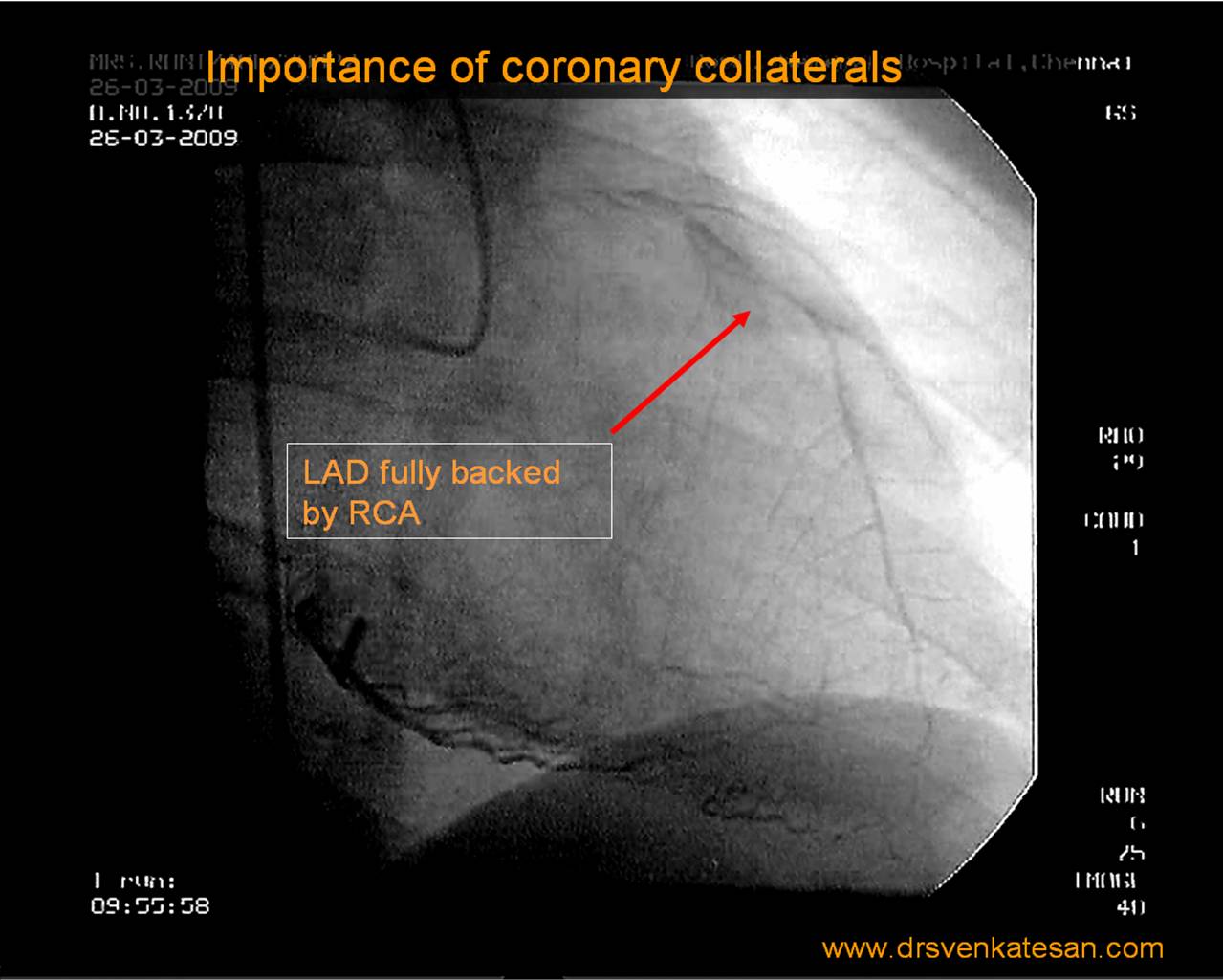 coronary-collateral