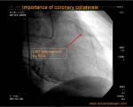 coronary-collateral