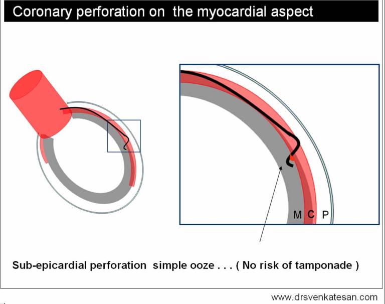 ellis classification of coronary perforation | Dr.S.Venkatesan MD