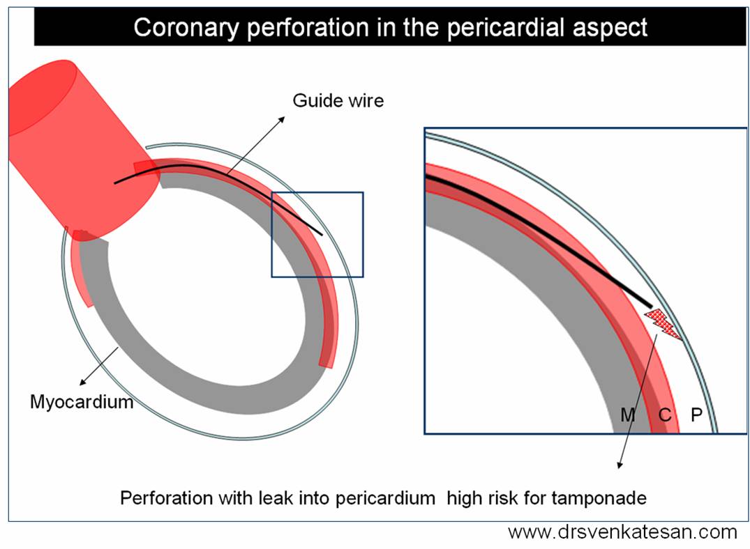 coronary-perforation