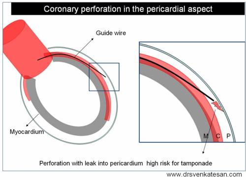 coronary-perforation