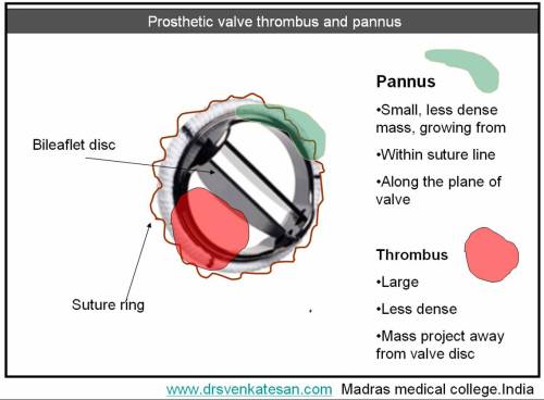 pannus-2