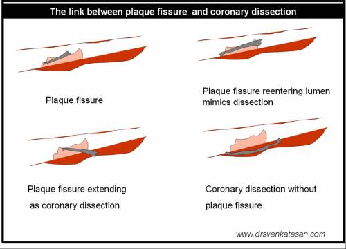 plaque-fissure-and-coronary-dissection