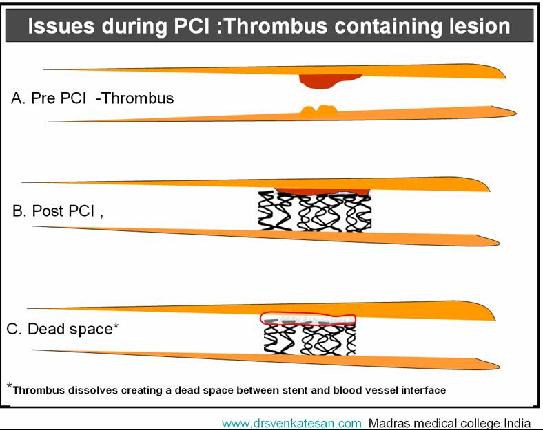 thrombus-and-pci