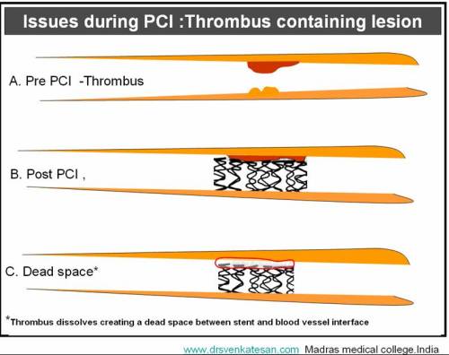 thrombus-and-pci