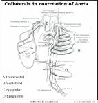 co-arctation-collaterals