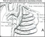 collaterals-in-coarctation-21