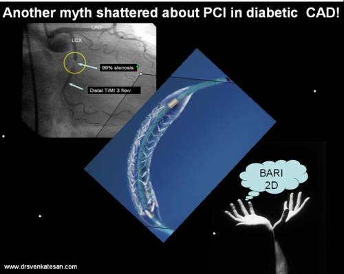 bari 2d  pci coronary