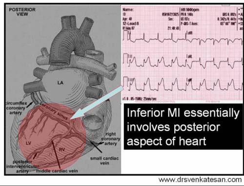 inferior MI ECG