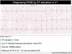 rvmi ecg