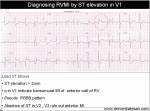 rvmi ecg