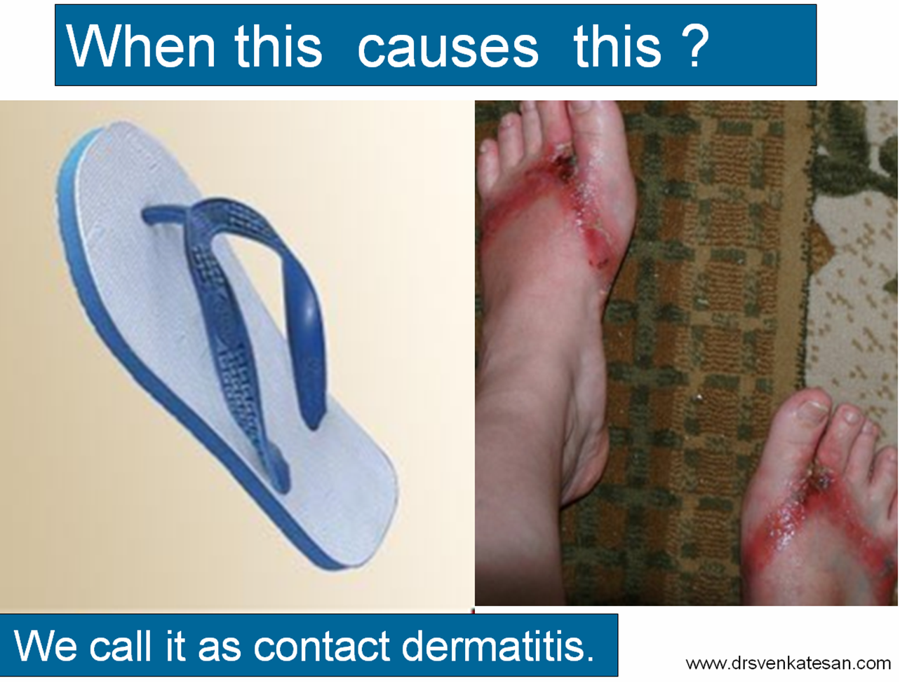 contact dermatits stent allergy pci coronary