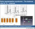 early repolarisation syndrome ers ecg primary vf