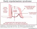 ers early repolarisation&nbsp;syndrome