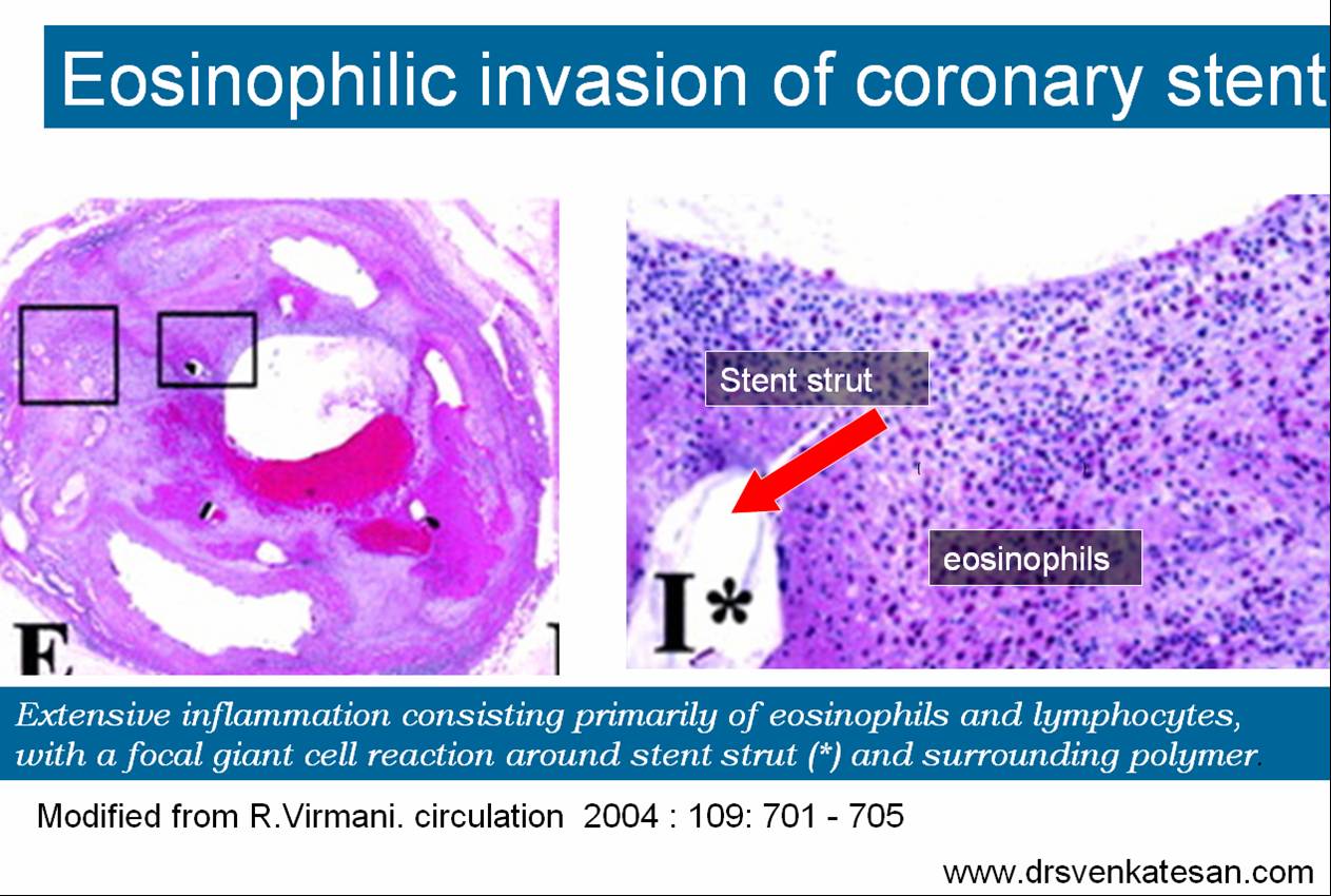 stent des rejection virmani  pci