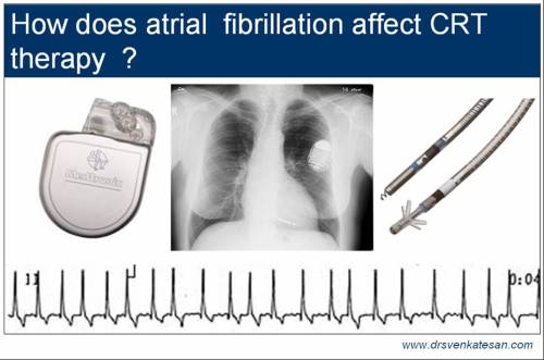 atrial fibrillation crt cardiac resynchronisation therapy icd madit crt care chf