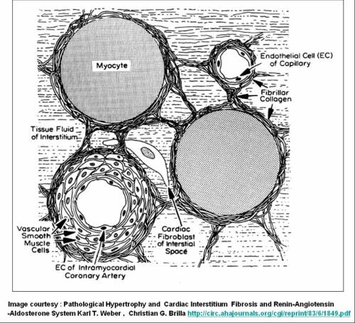 cardiac interstitum intersitial fibrosis amyloidosis