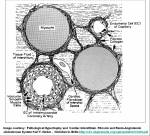 cardiac interstitum intersitial fibrosis&nbsp;amyloidosis