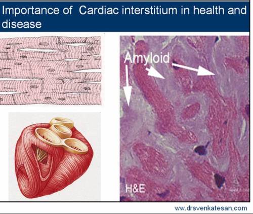 cardiac interstitum interstitial fibrosis myocardial
