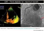 crt cardiac resynchronisation asynchrony echocardiography
