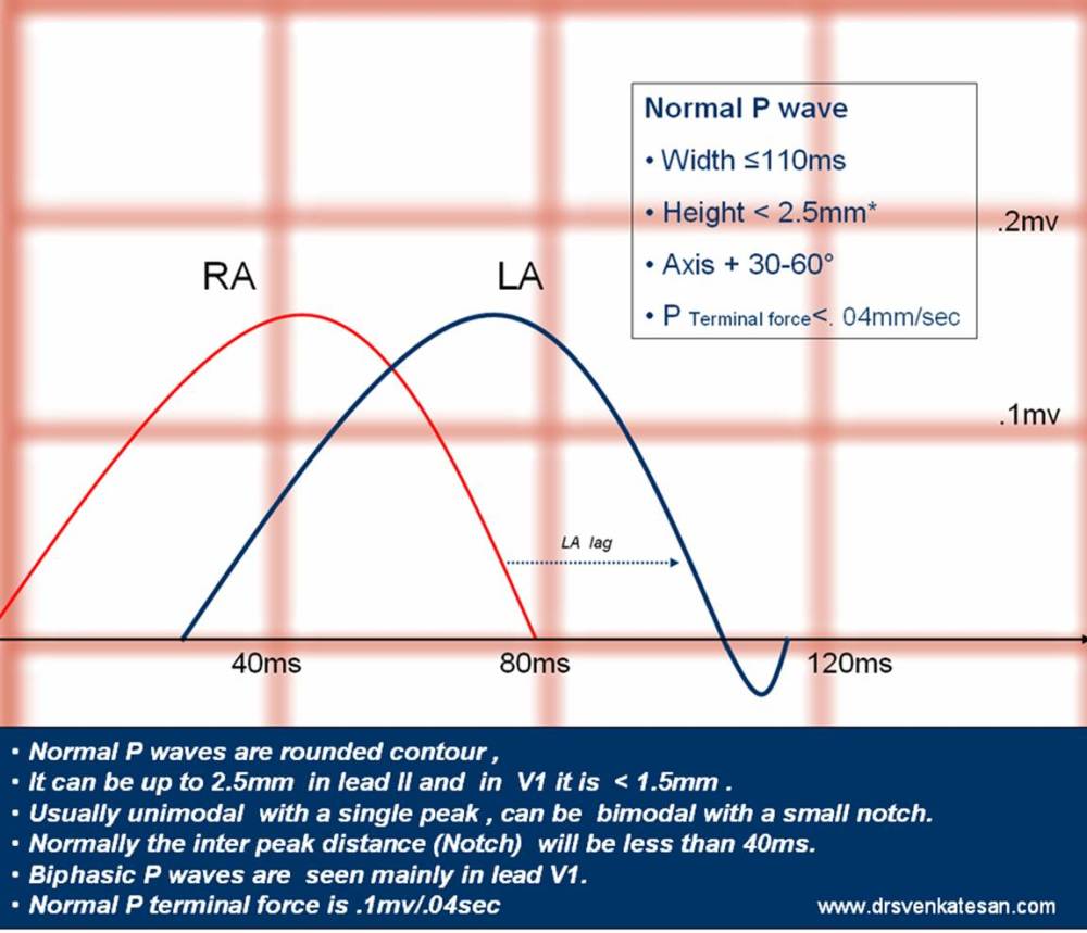 p wave abnormality in ecg | Dr.S.Venkatesan MD