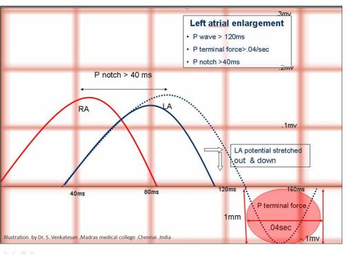 right and left atrial enlargement how to differentiate lae rae