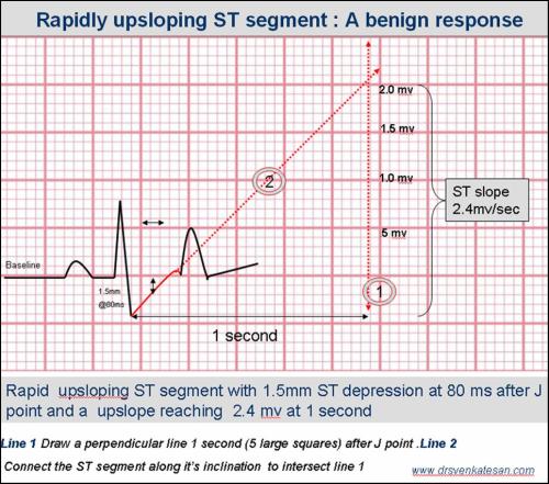 upsloping st segment tmt st slope ecg