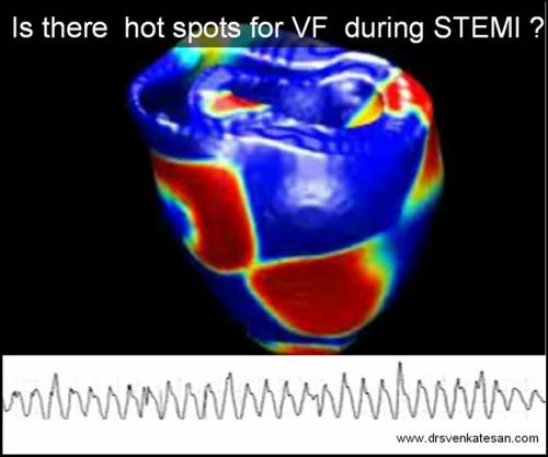 ventricular fibrillation ecg