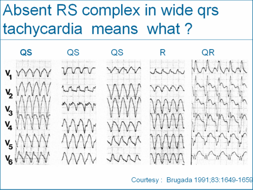wide qrs tachycardia vt svt aberrancy brugada