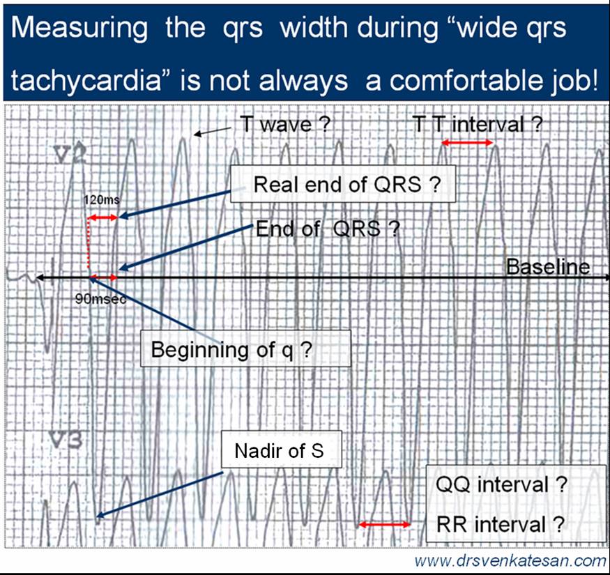 wide qrs tachycardia vt svt aberrancy