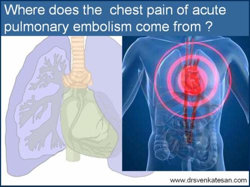pulmonary embolism chest pain dvt d dimer ventilation perfusion