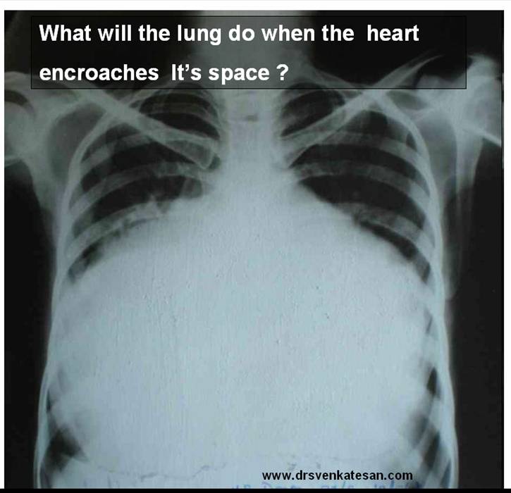 cardiomegaly massive dyspnea mechanism lvedp