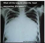 cardiomegaly massive dyspnea mechanism&nbsp;lvedp