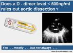 d dimer aortic dissection false lumen