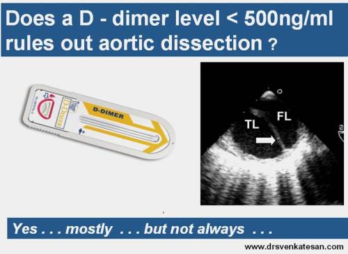 d dimer aortic dissection false lumen