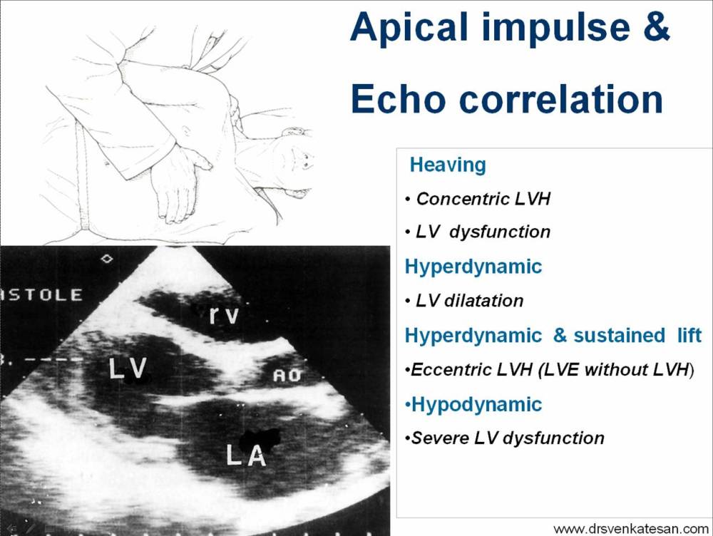 hyperdynamic apical impulse | Dr.S.Venkatesan MD