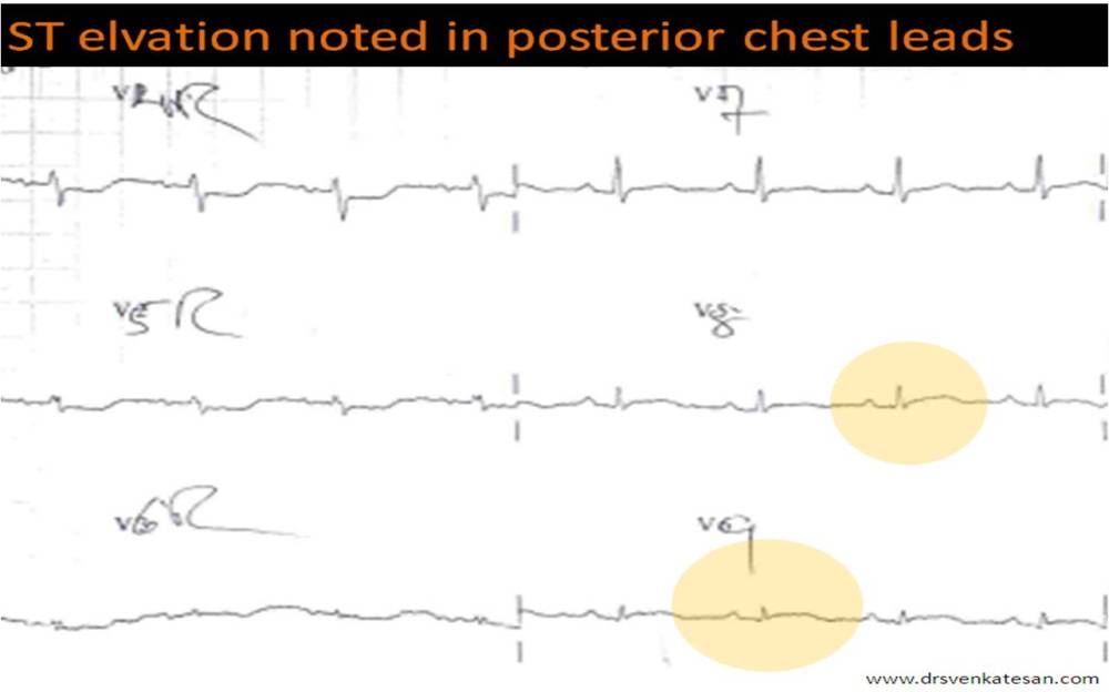 posterior stemi | Dr.S.Venkatesan MD
