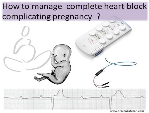 pregnancy and complete heart block chb congenital