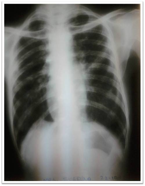 COPD tubular heart reduced ct ratio