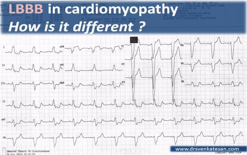 lbbb in cardiomyopathy organic lbbb