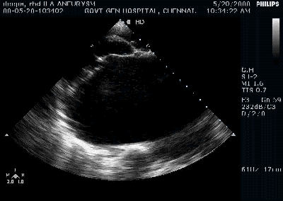 LA aneurysm