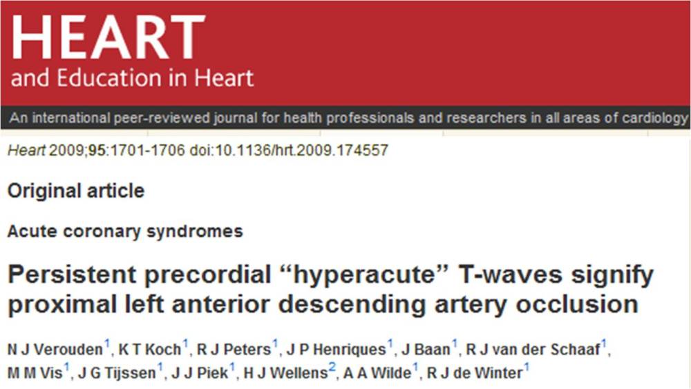 slowly evolving stemi | Dr.S.Venkatesan MD