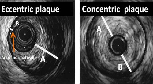 eccentric plaque concentric plaque eccentricity index acc aha plaque morphology bifurcation plaque
