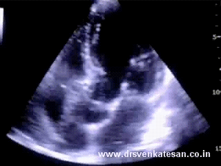 sigmoid ivs dynmic lvot obstruction 2