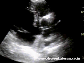 sigmoid ivs dynamic lvot obstruction